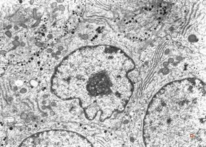 F, 51y. | acromegaly - acidophilic pituitary adenoma (STH)